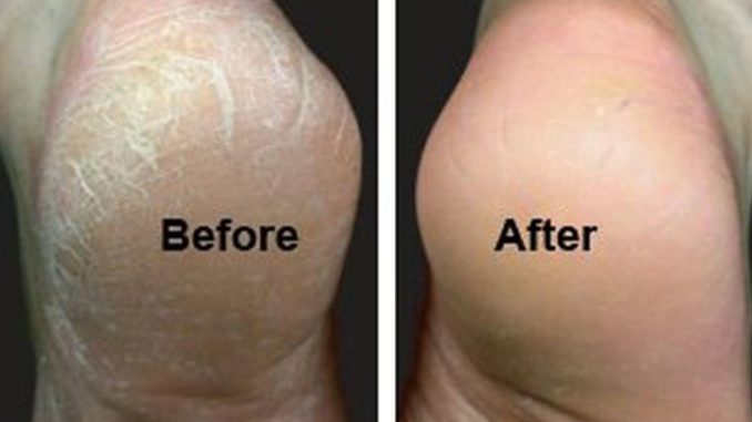 Dabanlardakı Sərtləşmiş Dəri: Səbəbləri, Qarşısının Alı ...