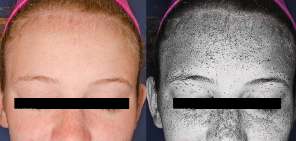 Vitamin D Çatışmazlığı və Günəş: Əhəmiyyəti, Səbəbləri  ...