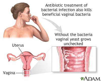 Vaginal Göbələk Xəstəliyi: Evdə Müalicəsi Mümkündürmü?